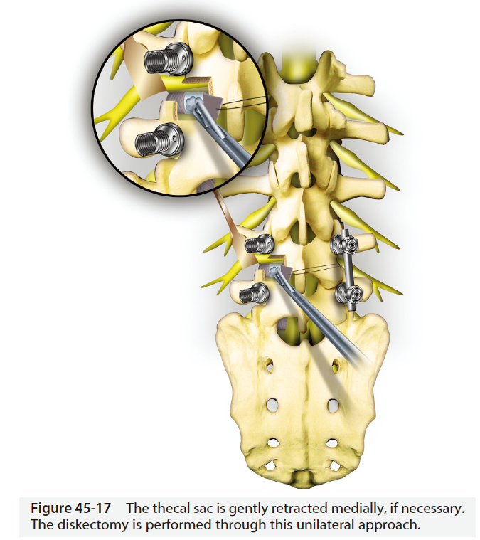 腰椎椎体间融合技术解析.png
